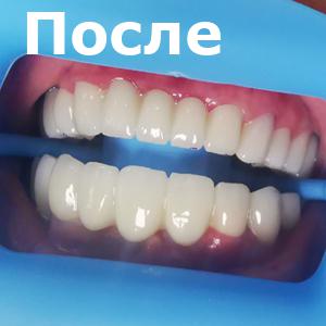 Результат протезирования всех зубов